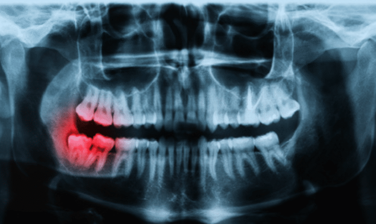 Dental-X-rays