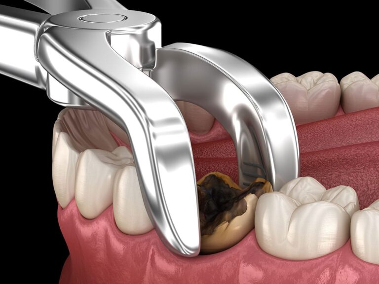 Wisdom_Tooth_Removal_img