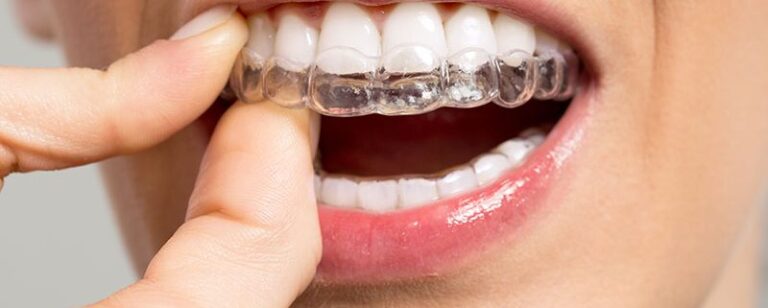 braces