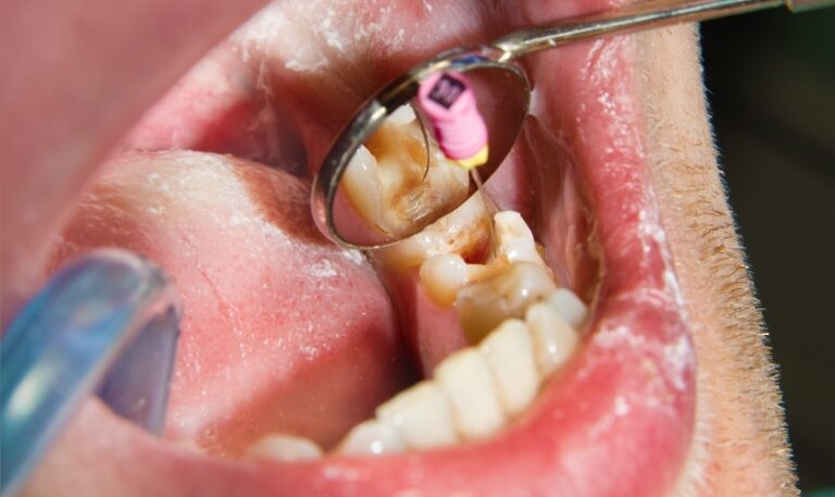 root-canal-recovering