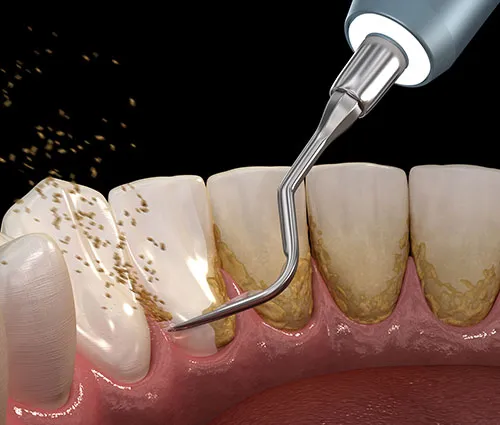 treatment-of-gum-disease